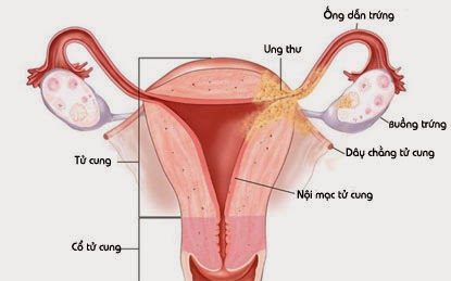 Bệnh Tăng sản nội mạc tử cung: Nguyên nhân, biến chứng và cách điều trị